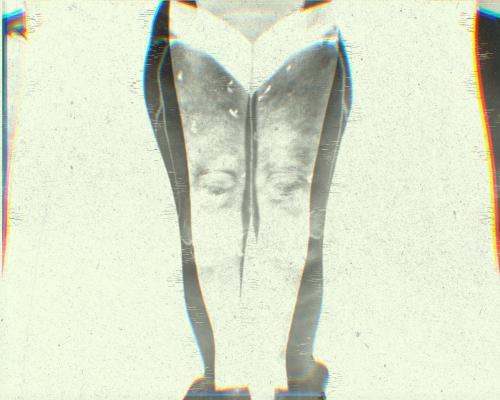 Puffy legs, heavy aches, rippled skin: what is lipedema?