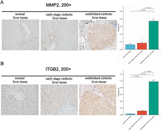 Exploring the roles of genes associated with leukocyte transendothelial migration in liver cirrhosis development