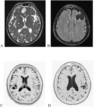 Subarachnoid neurocysticercosis in a rural area of the Bolivian Chaco: A population-based survey through the use of a novel urine antigen assay