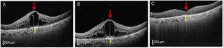 Real-world outcomes after switching to faricimab in treatment-resistant diabetic macular edema: A 1-year observational study with choroidal thickness assessment