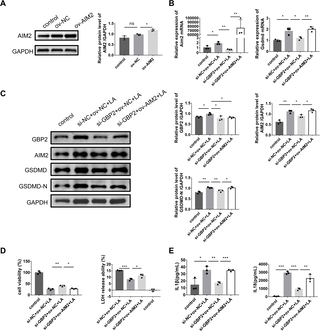 GBP2 promotes podocyte pyroptosis and contributes to the pathogenesis of pediatric lupus nephritis